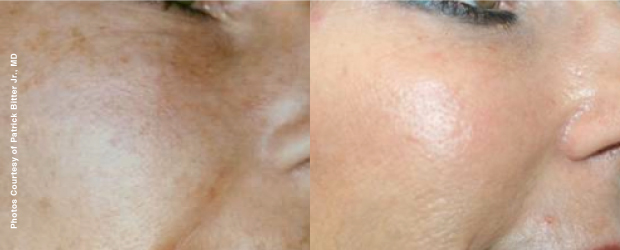 Before Treatment:38 years old After Treatment:49 years old After 11 years of Forever Young BBL Treatments, the skin looks younger...
