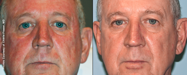 2 months after 2 Forever Young BBL treatments