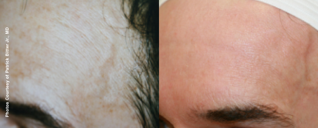 Before treatment 43 years old After treatment 55 years old After 12 years of Forever Young BBL treatments, the skin looks younger...