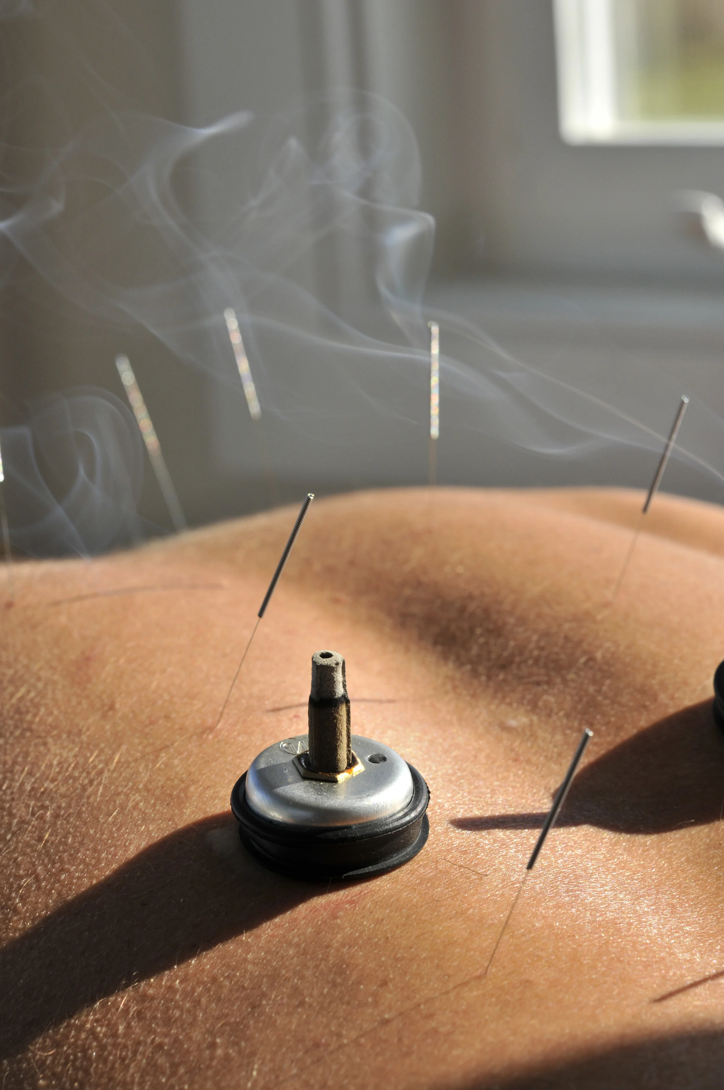 Acupuncture treatment with Moxibustion 