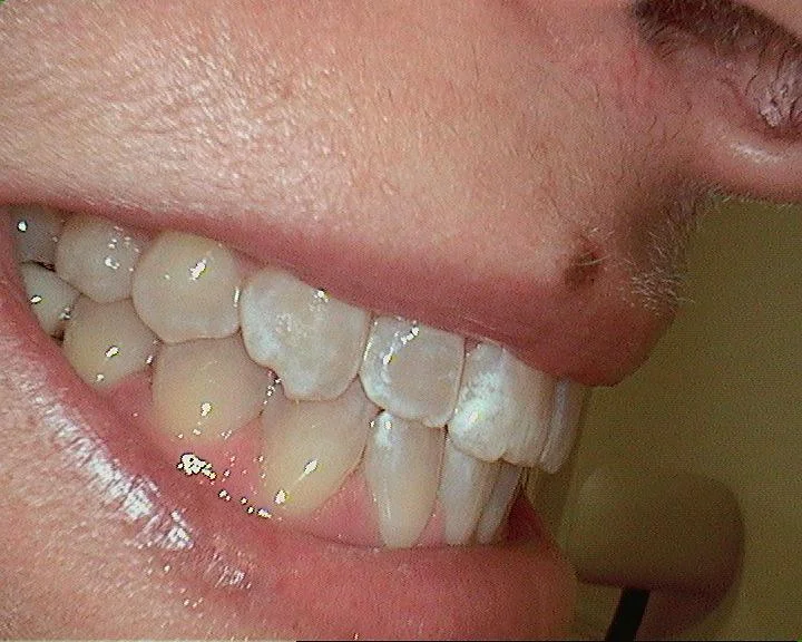 My teeth pre-whitening. 