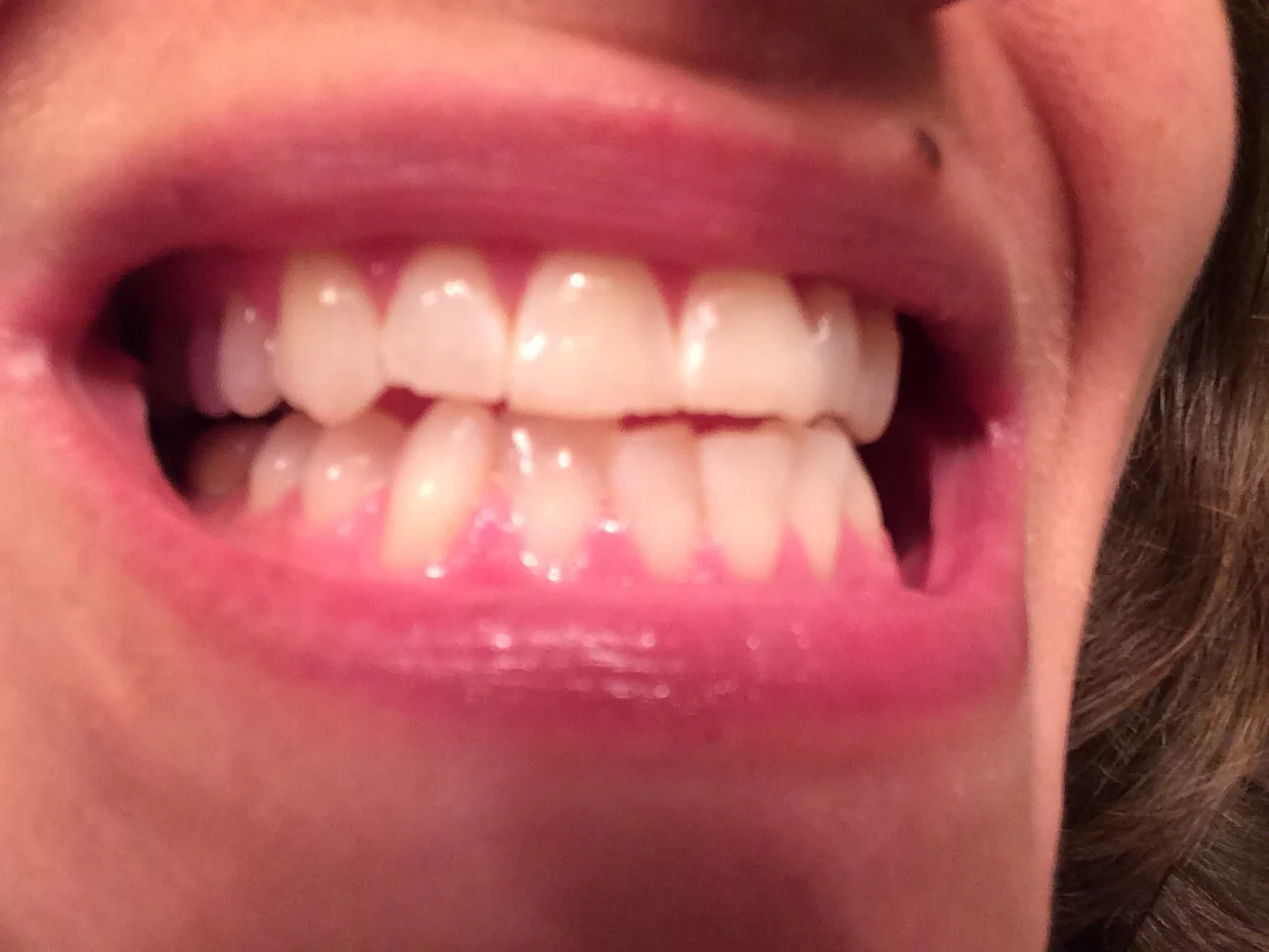 My chompers post-whitening. 