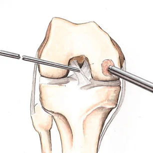 Stone Research Foundation publishes long-term study results in official ESSKA journal