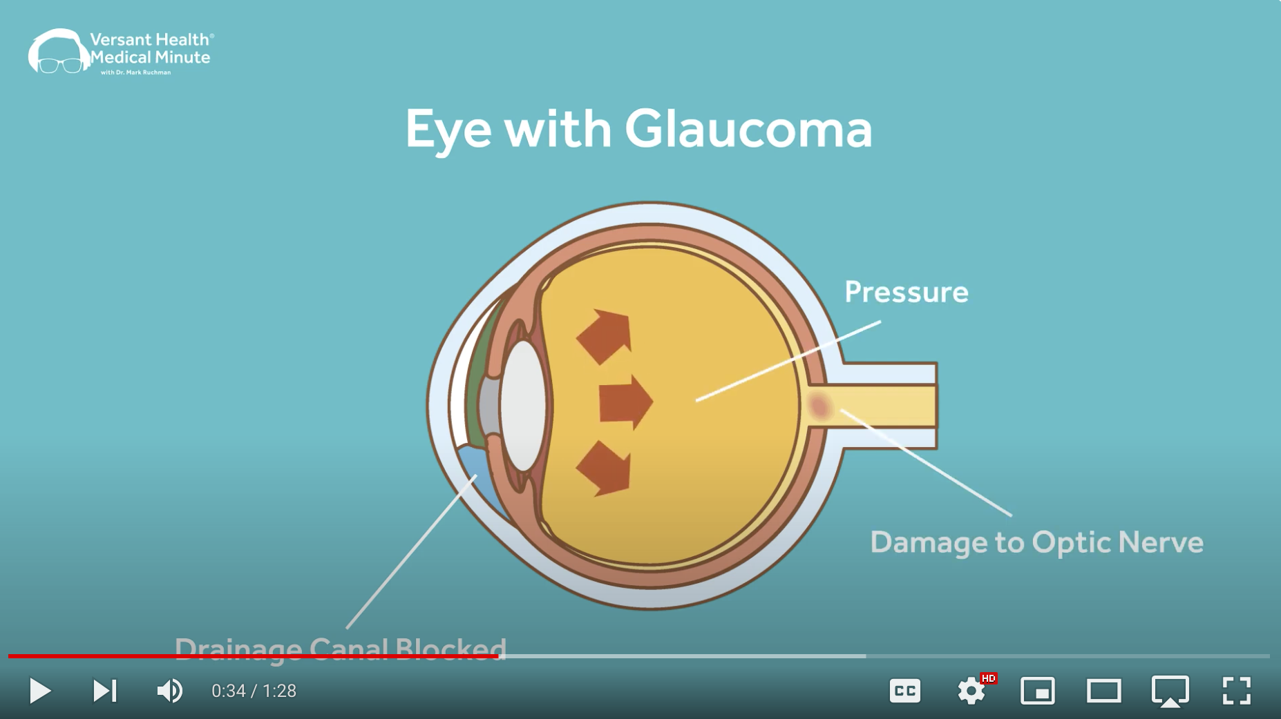 Medical Minute: Glaucoma Narrow