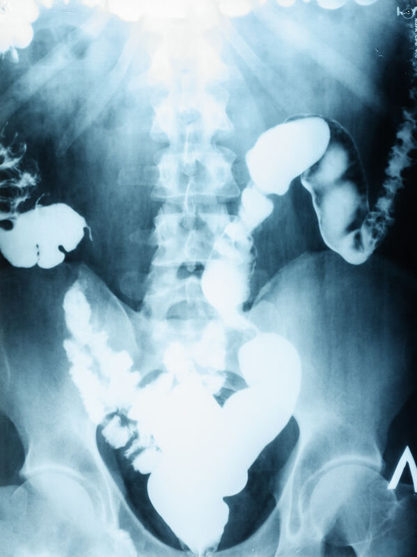 X-ray of the abdomen showing intestines and colon.