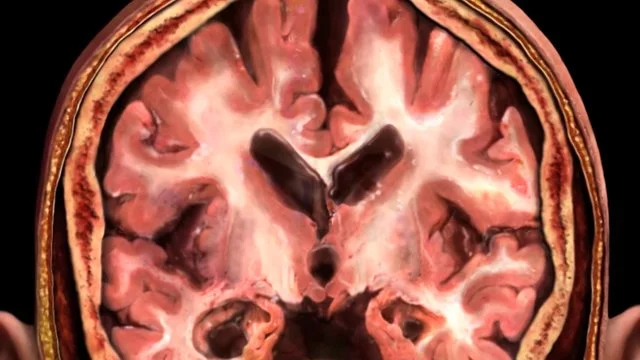 what is alzheimer's?