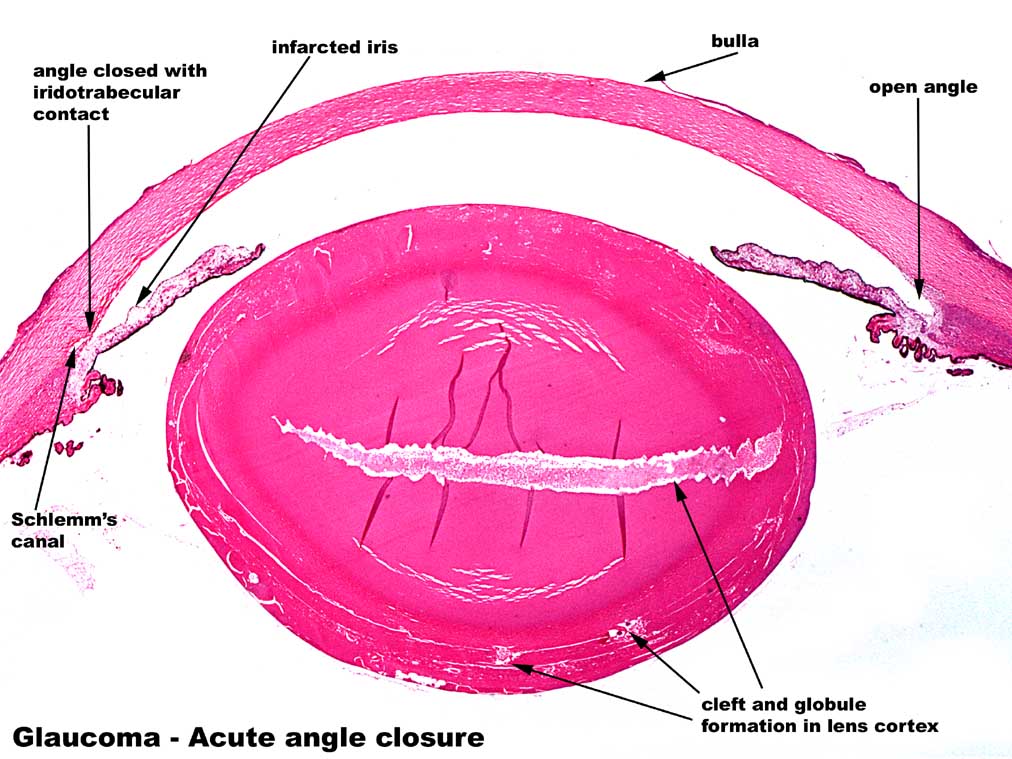 Weng Sehu Cataract Angle Closure Glaucoma.jpg