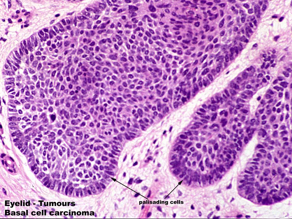 Weng Sehu Eyelid Basal Cell Carcinoma BCC.jpg