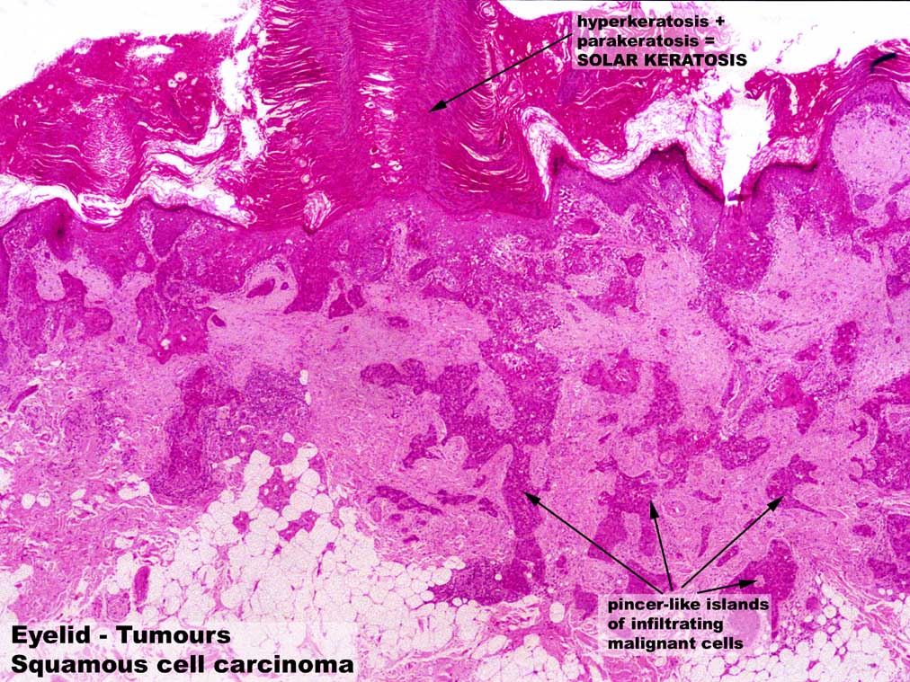 Weng Sehu Eyelid Squamous Cell Carcinoma SCC.jpg