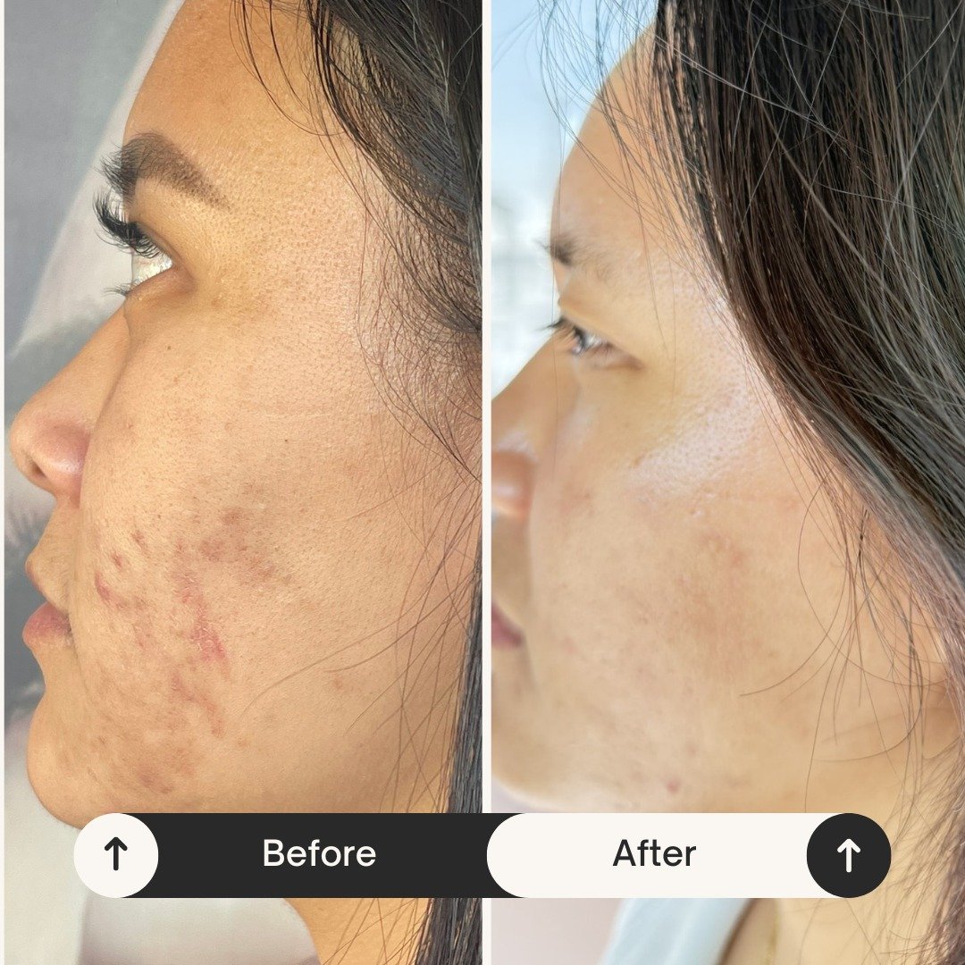 &ldquo;I had a really bad breakout&hellip; I used to wear a mask or makeup just to feel okay. Now, I don&rsquo;t need either. I feel confident walking out the door bare-faced.&rdquo; 💫 Julia

Her skin didn&rsquo;t just change; her confidence did too
