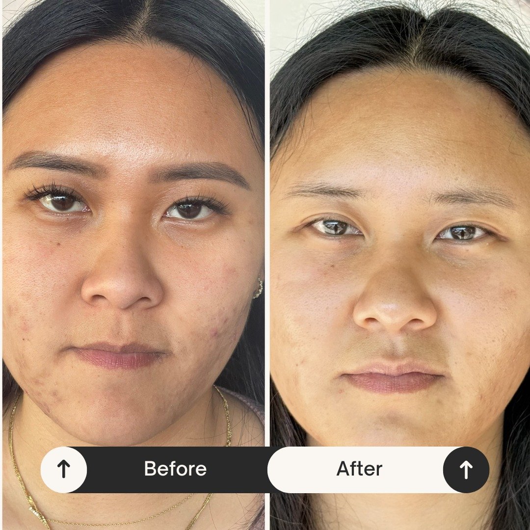 ✨ From Breakouts to Bare-Faced Confidence. ✨

Are acne or acne scars making you reach for makeup or a face mask every day? It&rsquo;s time to change that.

Let&rsquo;s build a customized plan to reveal clear, healthy, confident skin. No more hiding.
