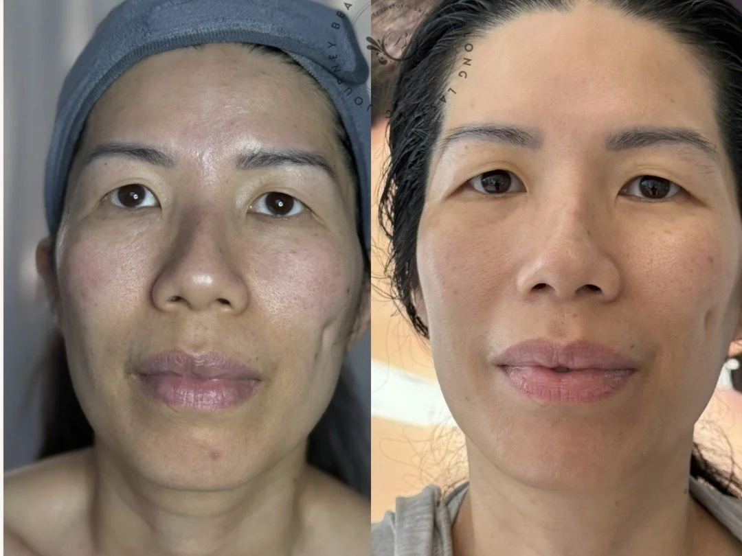 STOP SCROLLING &mdash; Milia for YEARS? See Hang&rsquo;s progress.
In April 2024, Hang had stubborn milia that wouldn&rsquo;t clear despite treatments.
We created a plan:

✅ 3-month focused treatment

✅ Daily home-care products

✅ Maintenance facials