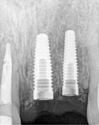 Dental implants digital x-ray image.