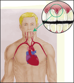 Diagram of gum disease