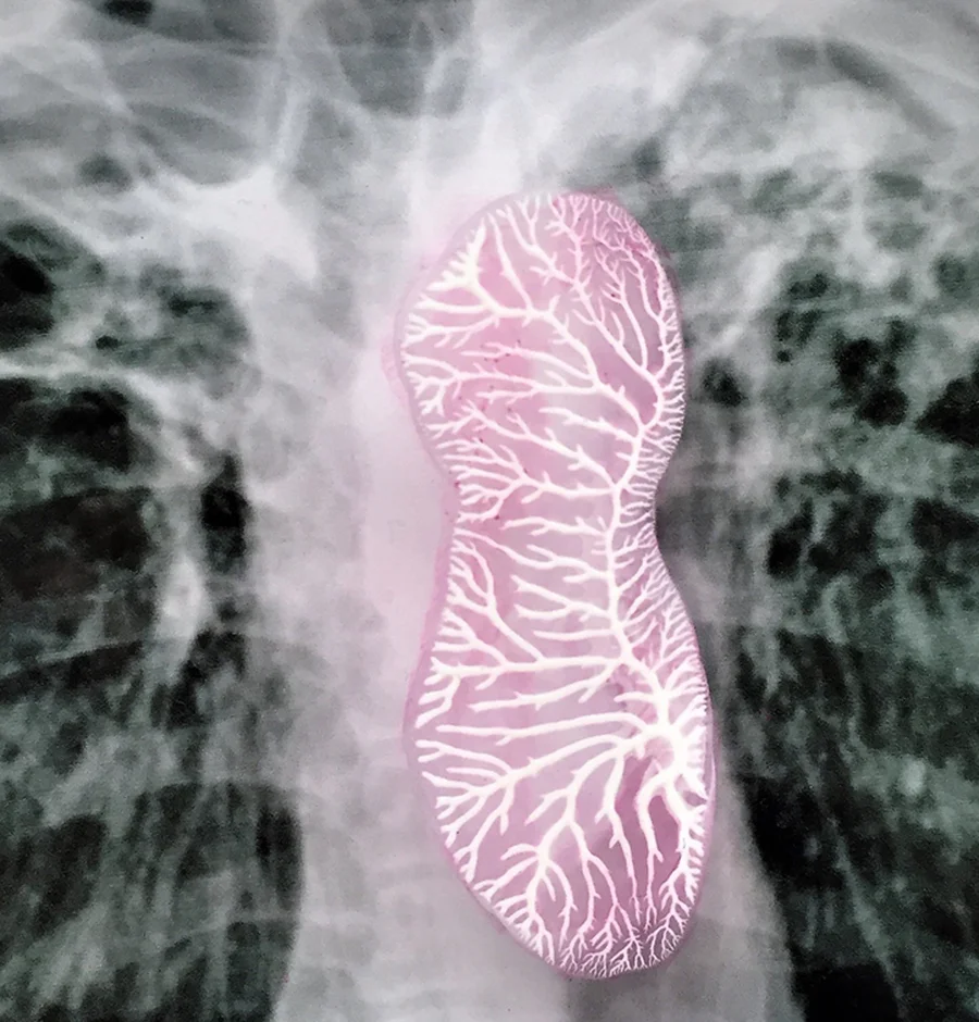 Contained (detail), 2018 Petri dish, digital photo of X-ray of lungs with Tuberculosis, ink drawing
