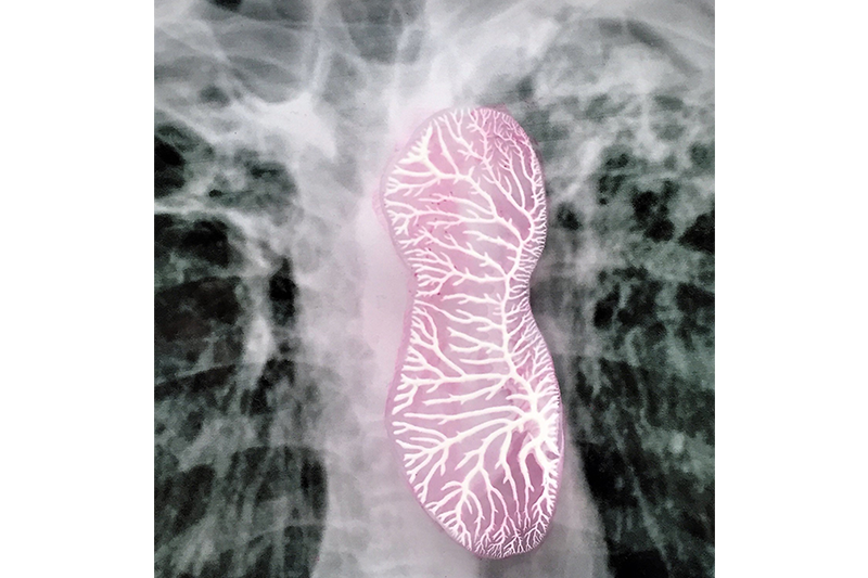   Contained    (detail), 2018 Petri dish, digital photo of X-ray of lungs with Tuberculosis, ink drawing 