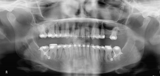 Traitement chirurgico-orthodontique. Préparation orthodontique : Pose
de plaque en T postérieures pour recul en masse de l’arcade mandibulaire
permettant la décompensation dento-alvéolaire visualisée par le redressement de
l’axe de l’incisive mandibulaire (chirurgie : JL Béziat)