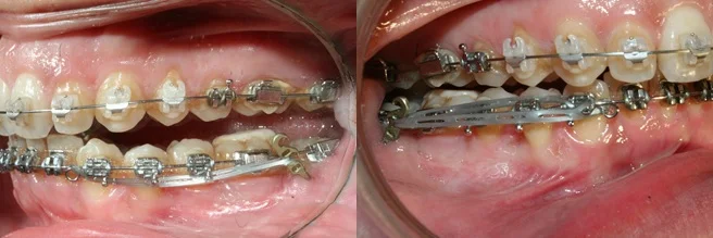 Préparation orthodontique pré-chirurgicale : correction des compensations
dento-alvéolaires. Traction par chaînettes élastomériques pour un recul en
masse et un redressement de l’axe de l’incisive mandibulaire par linguo-version
à partir de plaques vissées postérieures et après corticotomies. La traction
est effectuée en deux phases, la
chaînette élastomérique est appliquée sur la canine qui entraîne les secteurs
latéraux puis sur la boucle de l’arc pour un recul des incisives.