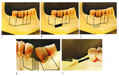 Schémas de différentes corticotomies en fonction du mouvement
recherché ;
a : alignement, b : ingression, c : égression, d :
fermeture d’espace, e : distalisation molaire, (schémas :JL Béziat,
2010).