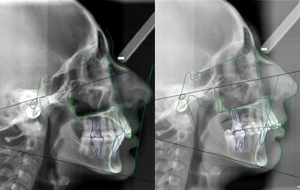 Plaques vissées et corticotomies. Après décompensation dento-alvéolaire,
sans extractions de prémolaires.