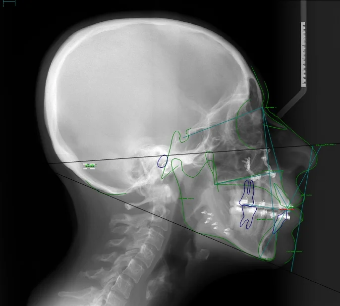 Céphalogramme post-chirurgie bi-maxillaire dont avancée mandibulaire
de 11mm,(chir :J L Béziat)