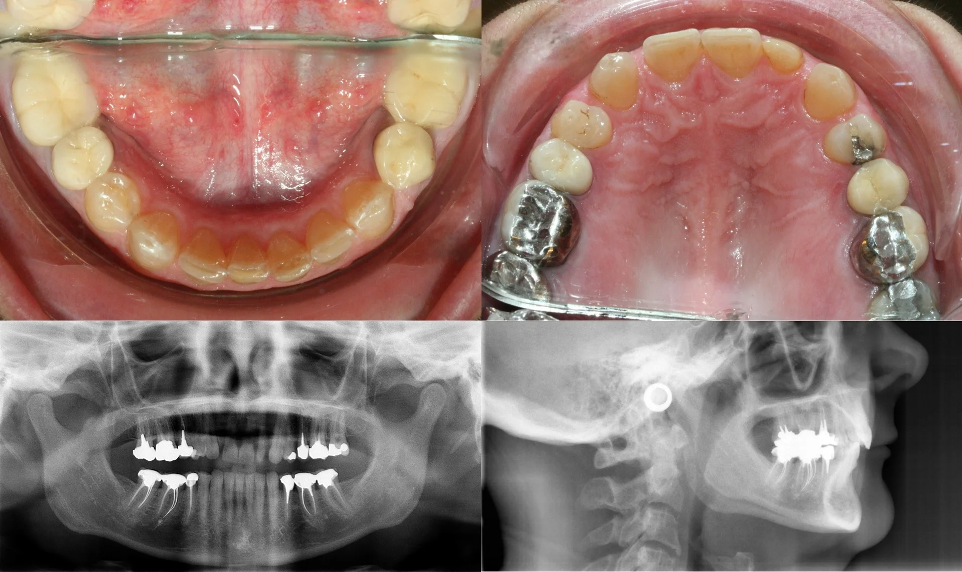 Orthodontie rapide - cas1.2 - apnee du sommeil.jpg