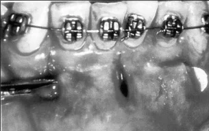 Réalisation d’un tunnel à l’aide d’un élévateur en vue de l’injection d’une
greffe osseuse (Sebaoun in Strippoli) 