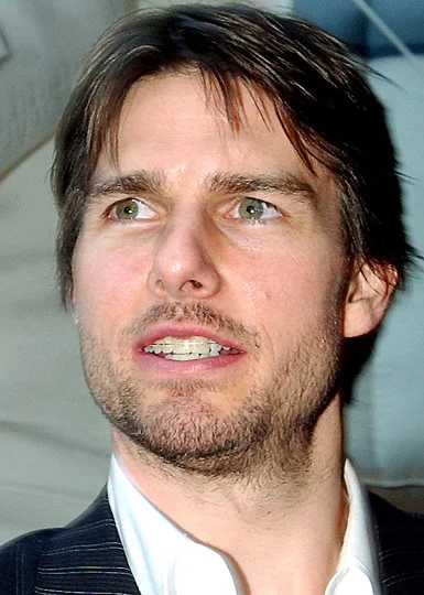 tom Cruise Braces.jpg