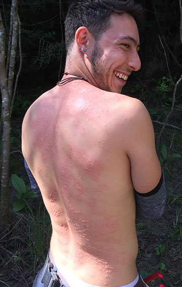 Herbalist Max Mulitz with 30 nettle lashes.