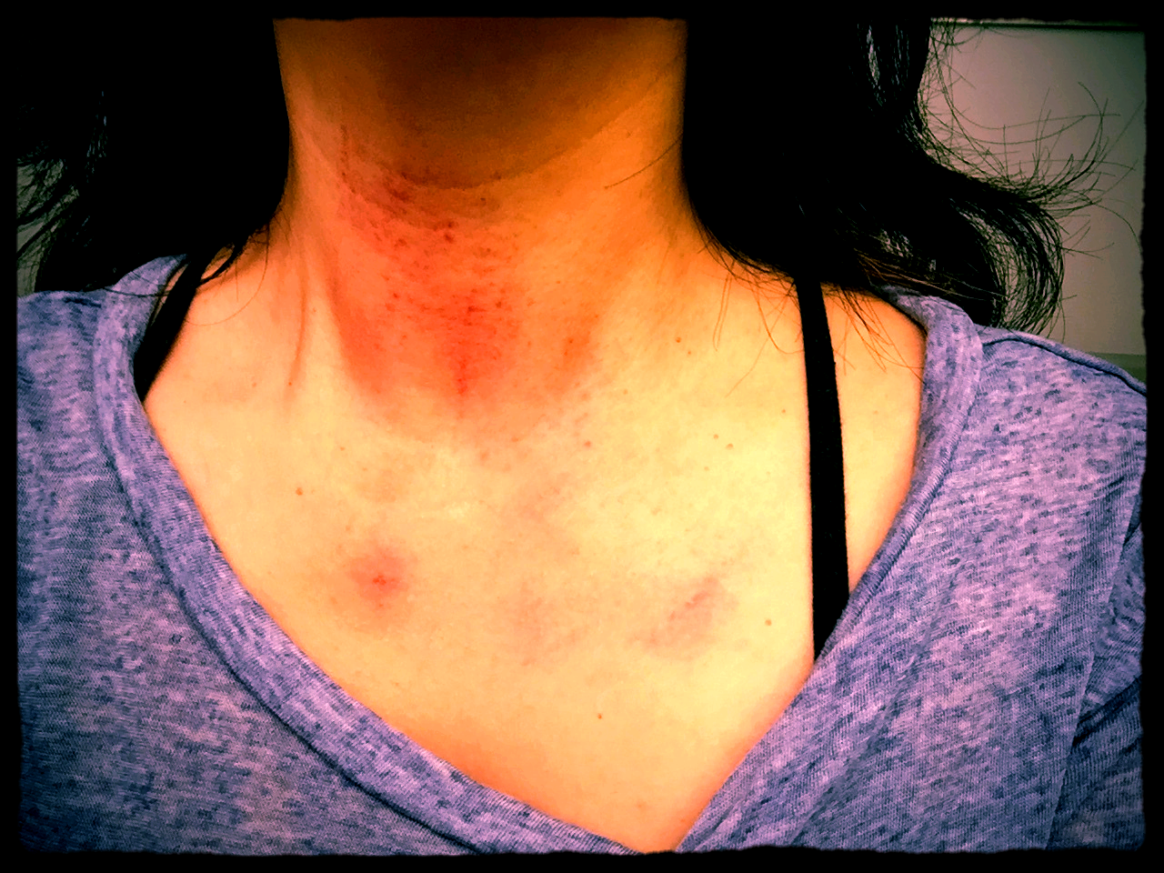 Punched in the throat by a metal bar