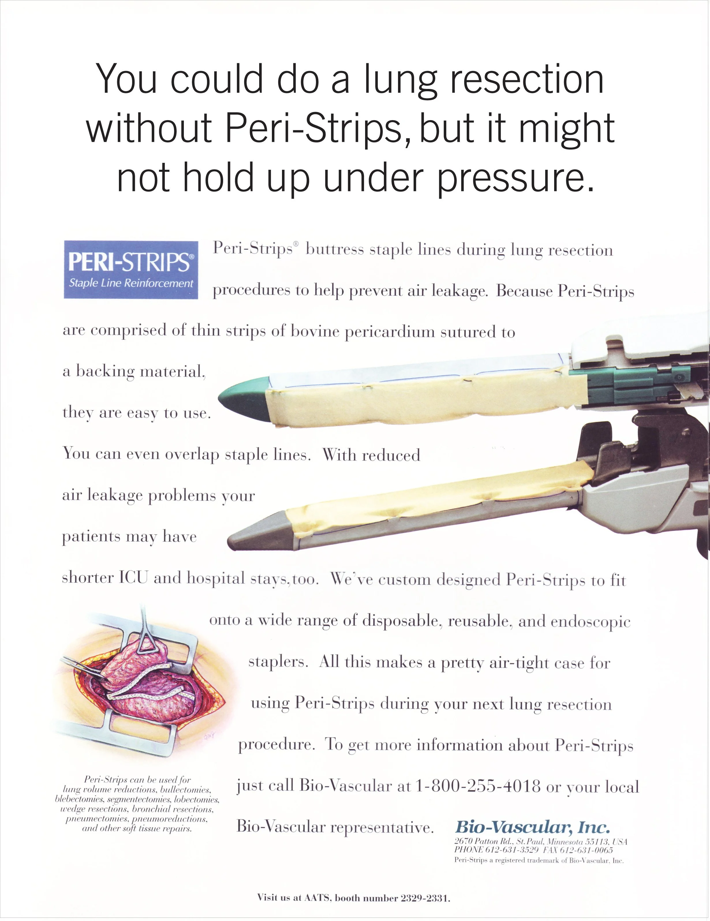 Peri-strips Ad Headline: You could do a lung resection without Peri-Strips, but it might not hold up under pressure. Pictures of surgical stapler and lung resection.