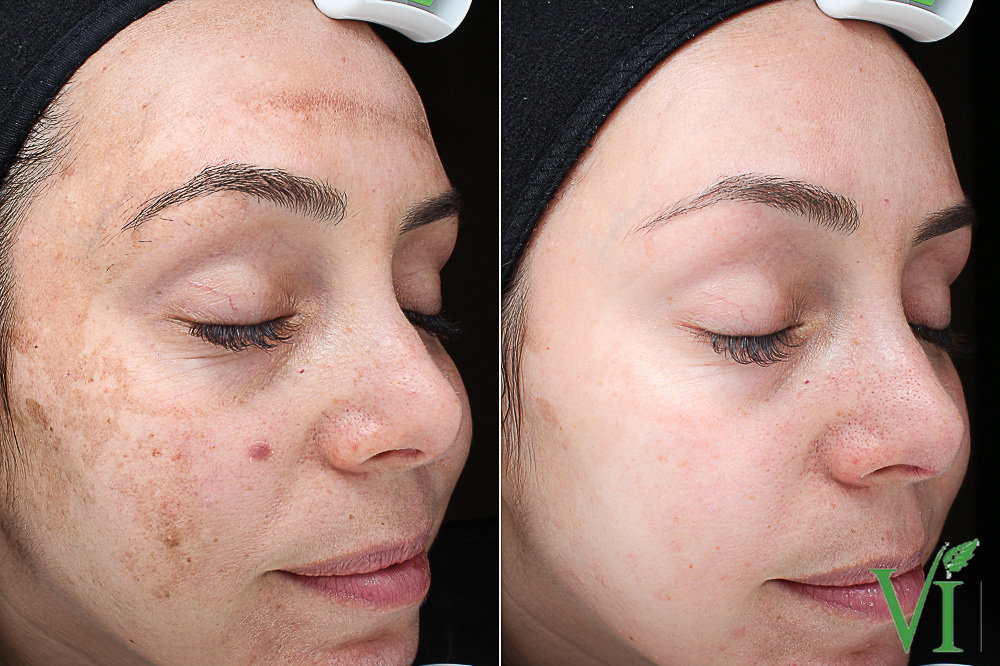 Melasma 1.jpg