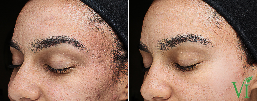 Acne and Acne Scarring - PIH.jpg