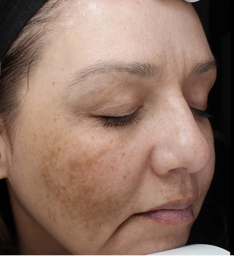 Skin after treatment