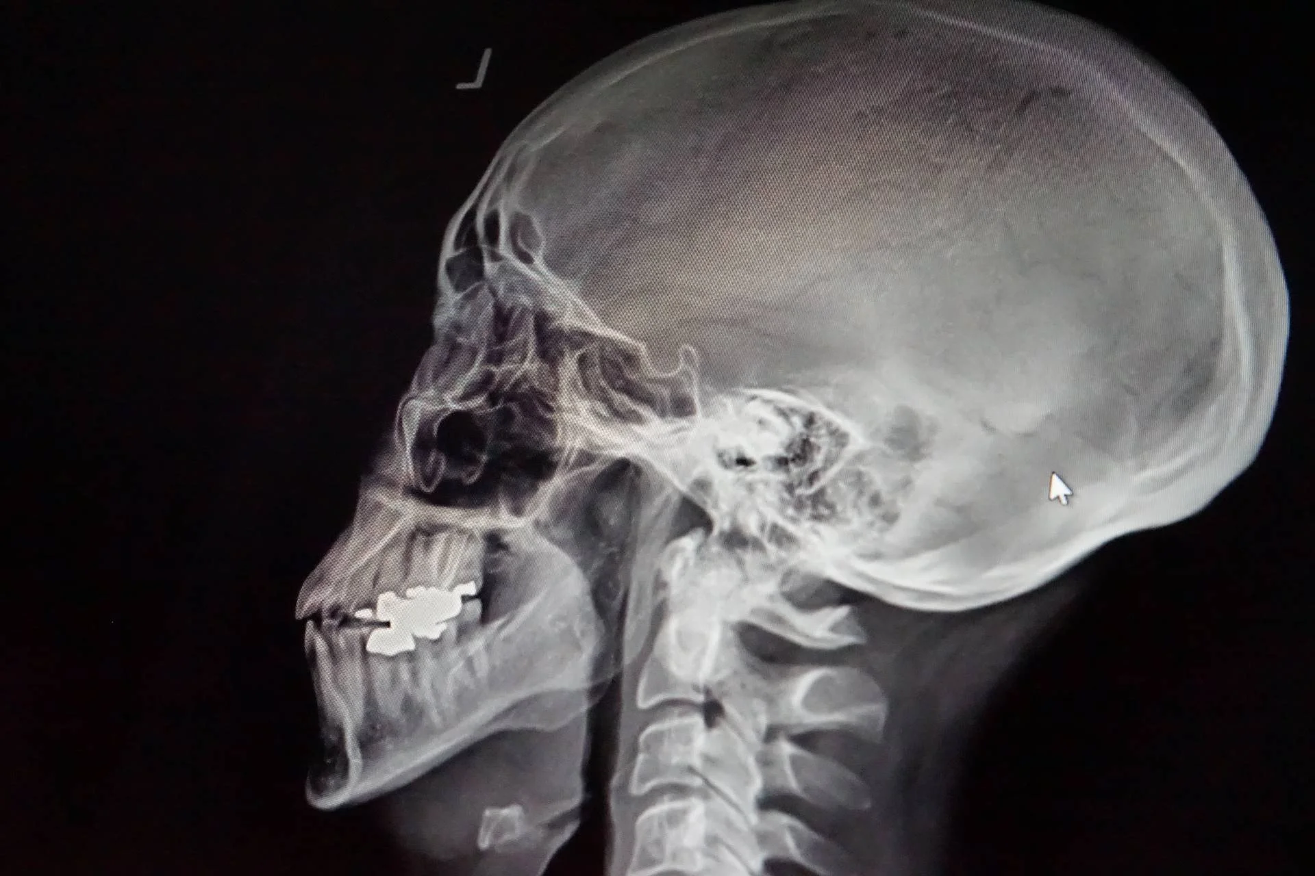 X-Ray-of-Upper-Cervical-Correction.jpg