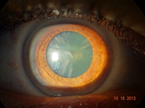 Cataract