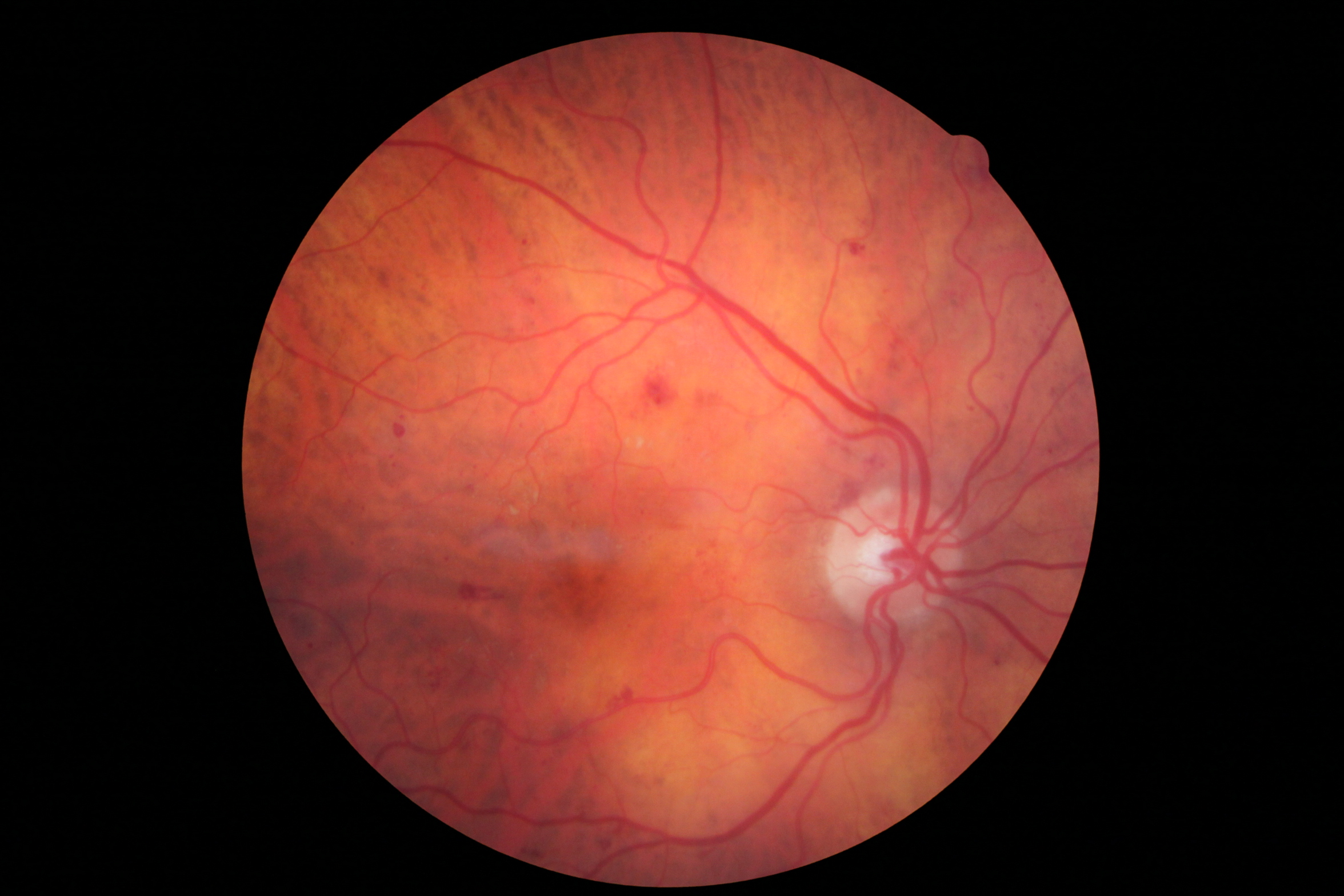 Diabetic Retinopathy. Note the hemorrhages and small white exudates.