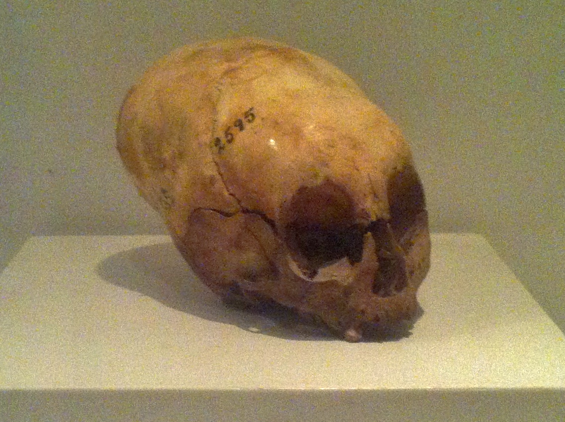 This was a child's skull. Under the Inca, as well as other native American civilizations, head-binding was part fashion statement, part cultural rite (not unlike foot-binding in Imperial China...or plastic surgery) 
