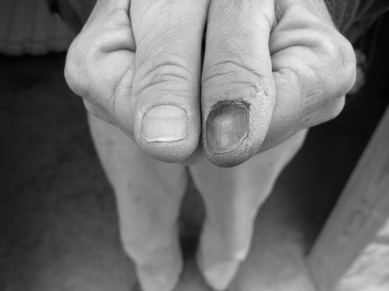 13 January 2015: This happened early on but the effects are everlasting. Van's thumb after he hammered into it, several weeks later.