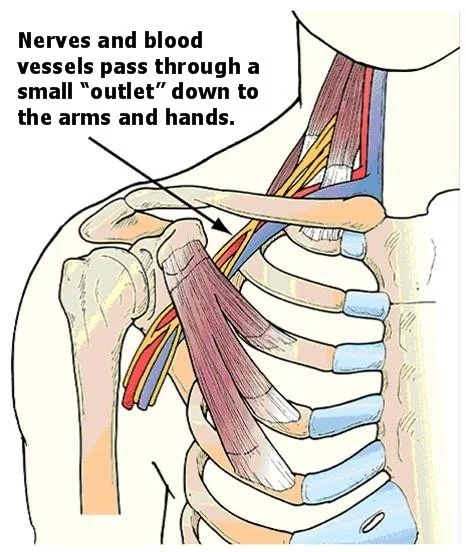 Thoracic Outlet Syndrome