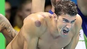 Cupping for Gold: Olympians Covered in Spots!
