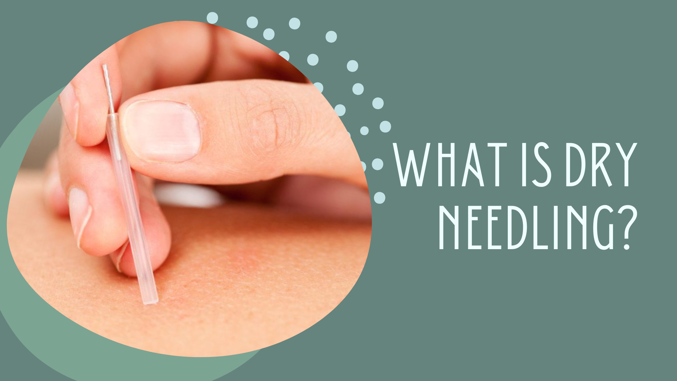 What Is Dry Needling?