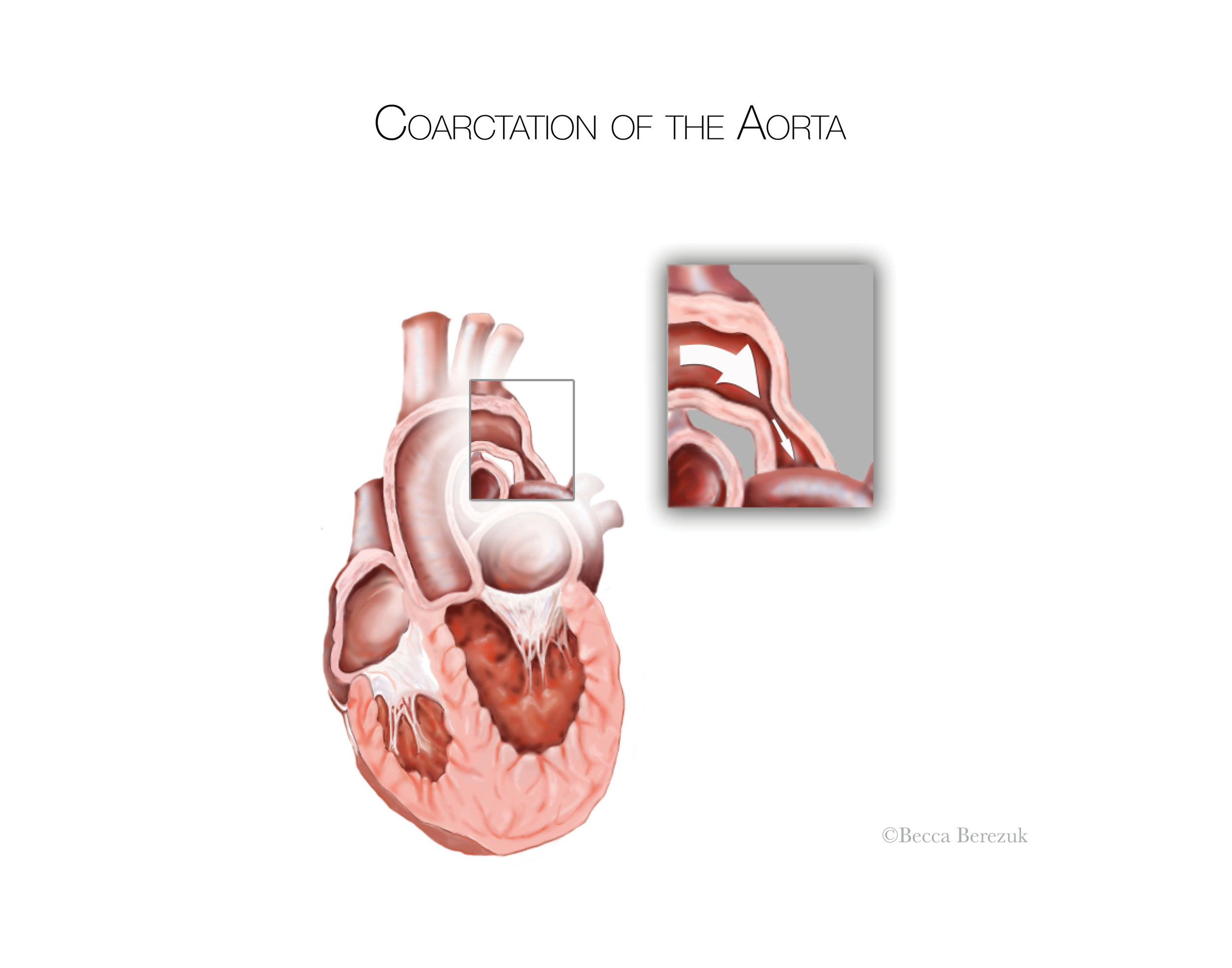  Coarctation of the Aorta,  Adobe  Photoshop  and Illustrator  