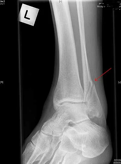 Broken Ankle