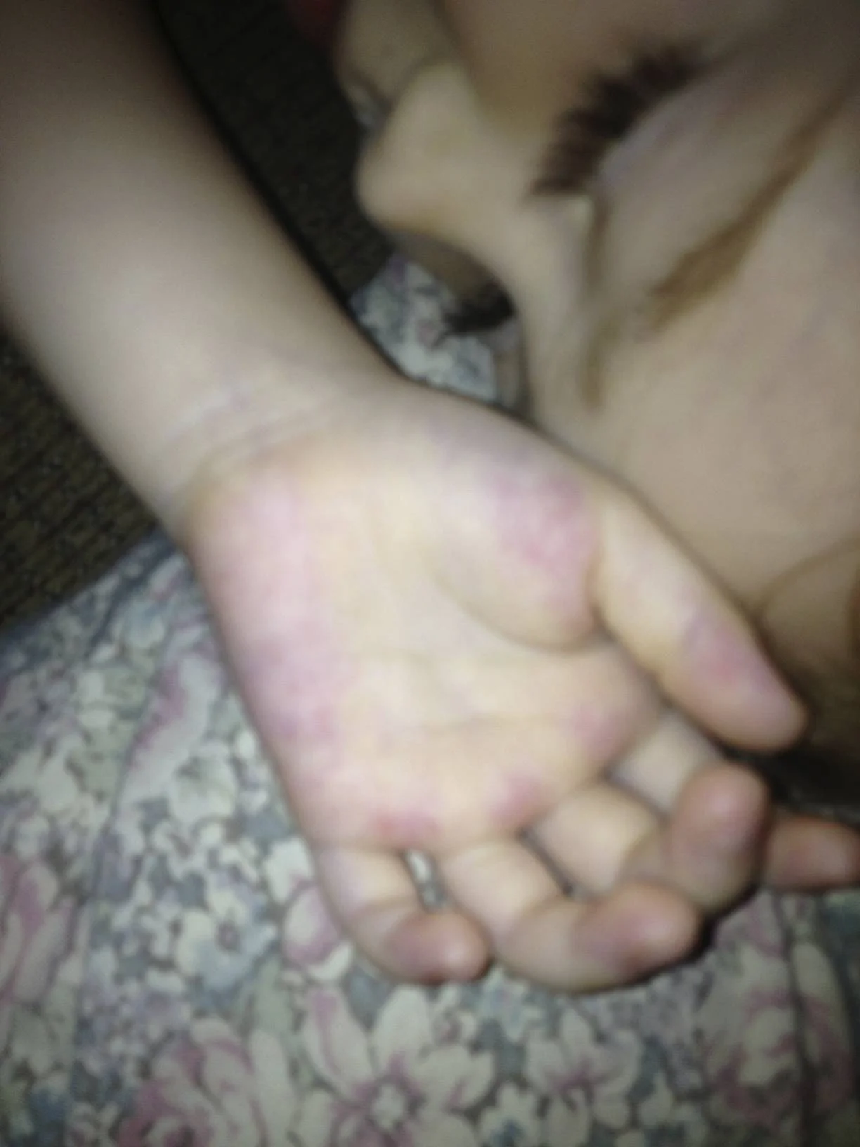 Hand Petechiae hours before going to ER