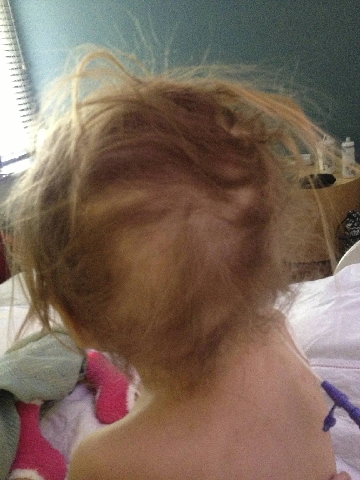 hair loss