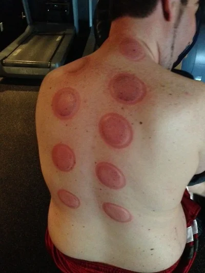 Cupping_Therapy2.jpg