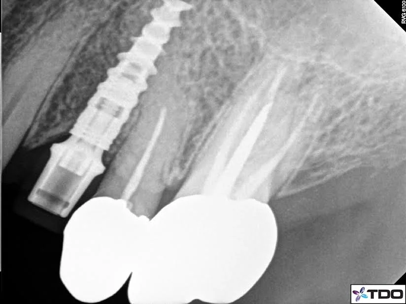  Pre-op