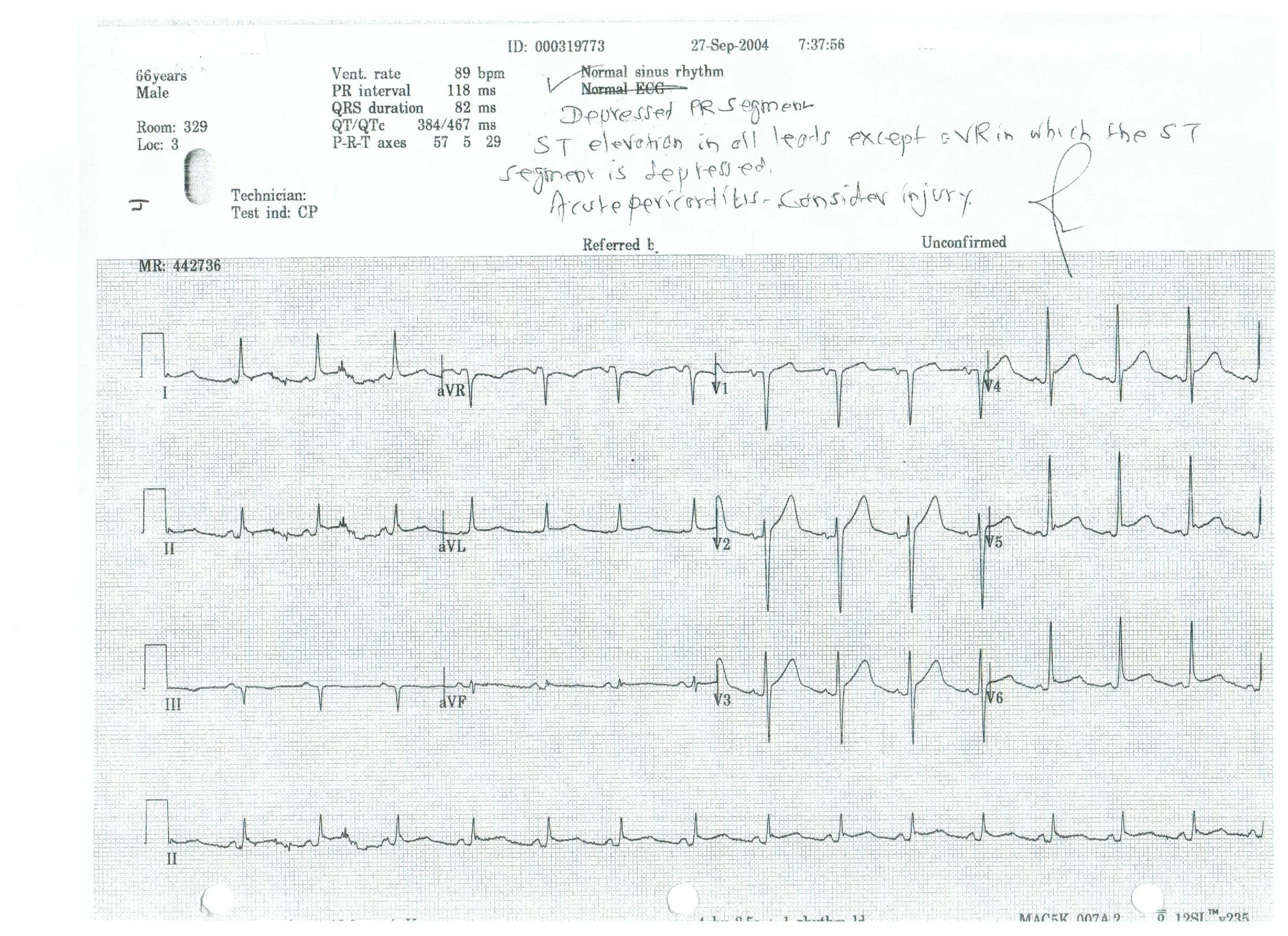    Normal sinus rhythm      Depressed PR segment      ST elevation in all leads except aVR in which the ST segment is depressed      Acute Pericarditis---consider injury   