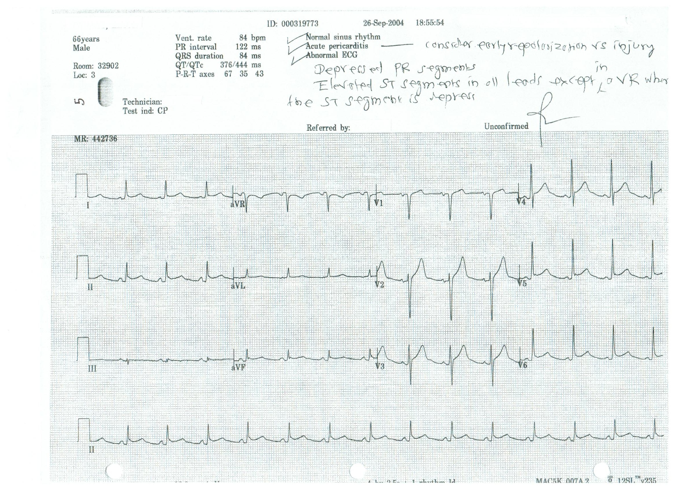    Normal sinus rhythm      Acute pericarditis---consider early repolarization vs injury      Depressed PR segments      Elevated ST segments in all leads except in aVR where the ST segment is depressed   